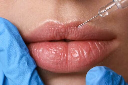 Russian Lips come nuova tecnica per il filler labbra