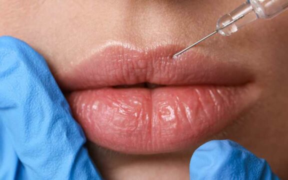 Russian Lips come nuova tecnica per il filler labbra