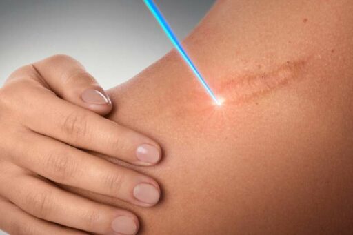 Recupero cicatrici post operatorie con Luce Blu
