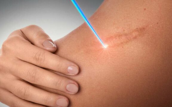 Recupero cicatrici post operatorie con Luce Blu