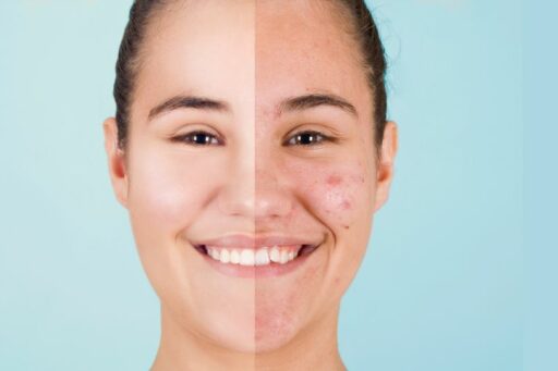 Laser frazionato CO2 per eliminare cicatrici e segni di invecchiamento