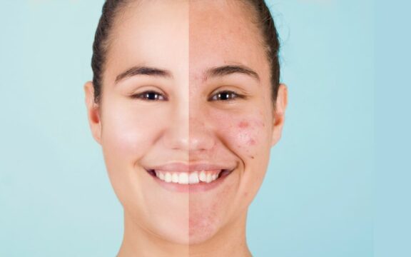 Laser frazionato CO2 per eliminare cicatrici e segni di invecchiamento