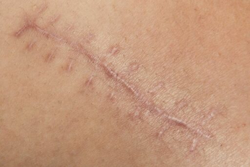 Vulnoterapia per la cura di cicatrici post operatorie, ferite e ulcere