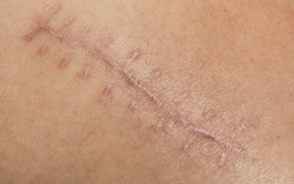 Vulnoterapia per la cura di cicatrici post operatorie, ferite e ulcere