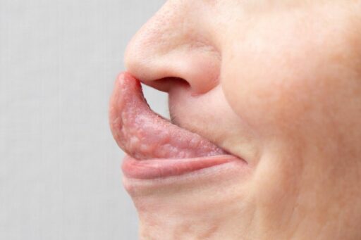 Punta del naso grossa dopo rinoplastica