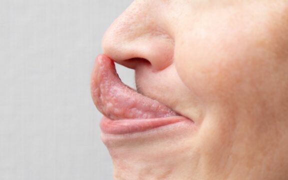 Punta del naso grossa dopo rinoplastica