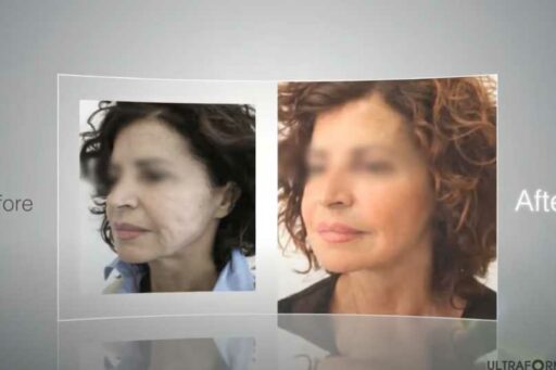 Ultraformer 3 per effetto lifting e liposuzione senza chirurgia