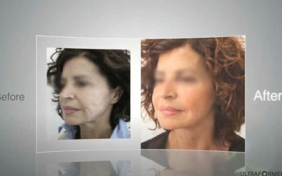 Ultraformer 3 per effetto lifting e liposuzione senza chirurgia