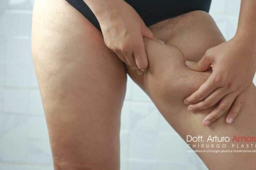 Lifting crurale per eliminare il grasso dalle cosce