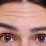 Frontoplastica per rimodellare la fronte