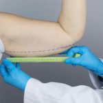 Lifting braccia (Brachioplastica): quando la chirurgia &egrave; la soluzione definitiva