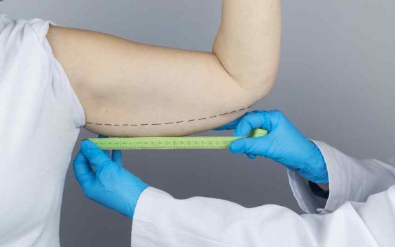 lifting braccia napoli - Lifting braccia (Brachioplastica): quando la chirurgia &egrave; la soluzione definitiva