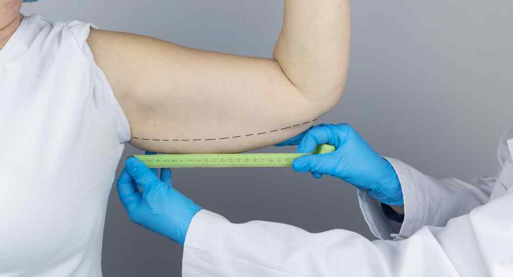 lifting braccia napoli - Lifting braccia (Brachioplastica): quando la chirurgia &egrave; la soluzione definitiva