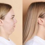 Mentoplastica: ridefinire il mento con o senza protesi