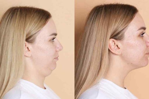 mentoplastica napoli - Mentoplastica: ridefinire il mento con o senza protesi