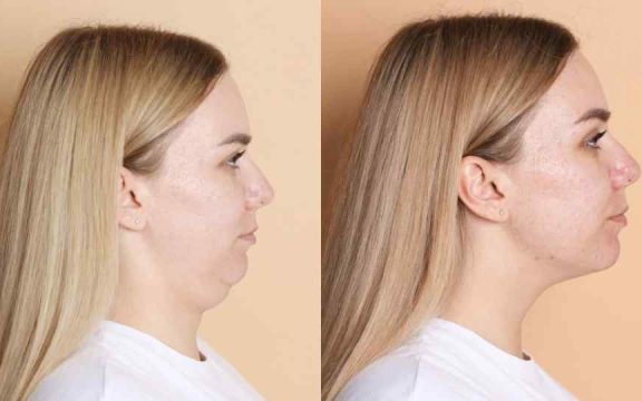 mentoplastica napoli - Mentoplastica: ridefinire il mento con o senza protesi