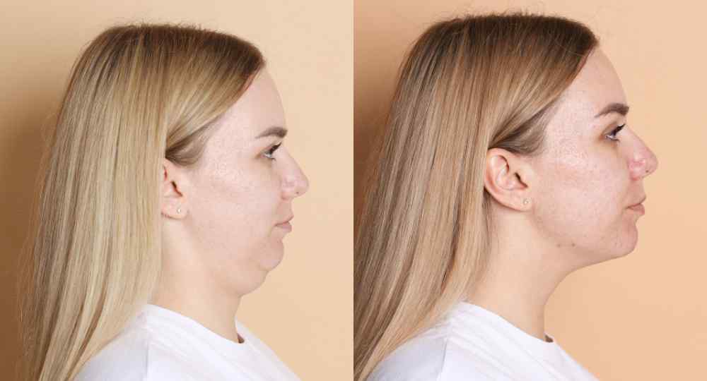 mentoplastica napoli - Mentoplastica: ridefinire il mento con o senza protesi