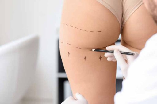 gluteoplastica napoli - Gluteoplastica: protesi sottomuscolare e fat grafting intramuscolare