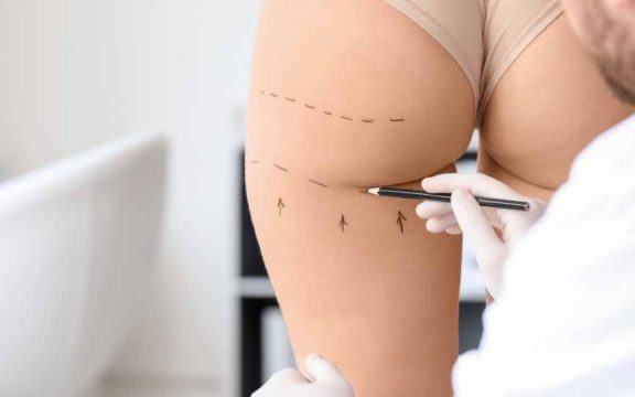 gluteoplastica napoli - Gluteoplastica: protesi sottomuscolare e fat grafting intramuscolare