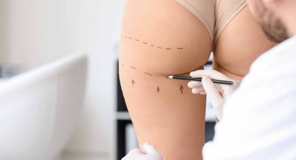 gluteoplastica napoli - Gluteoplastica: protesi sottomuscolare e fat grafting intramuscolare
