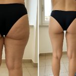 Liposuzione cosce e glutei: rimodellamento delle gambe